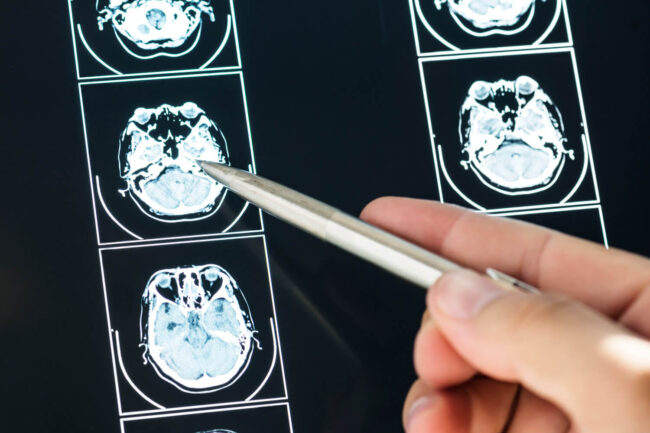 Muerte súbita por epilepsia